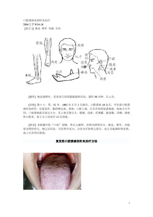 口腔溃疡炎的针灸治疗