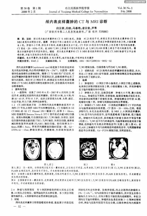 颅内表皮样囊肿的CT与MRI诊断