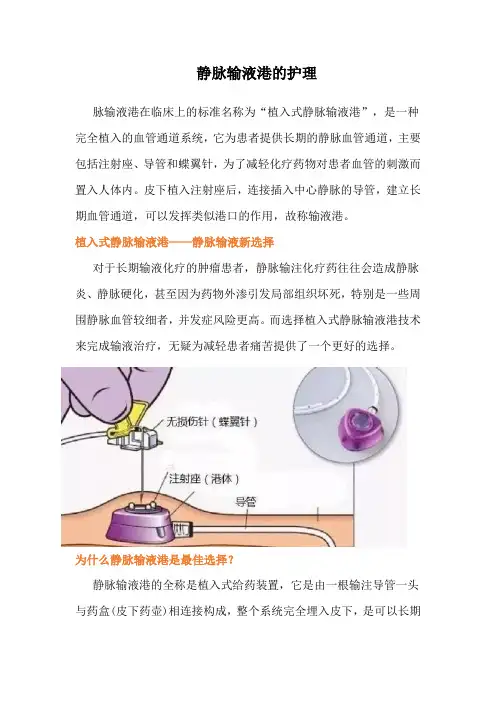 静脉输液港