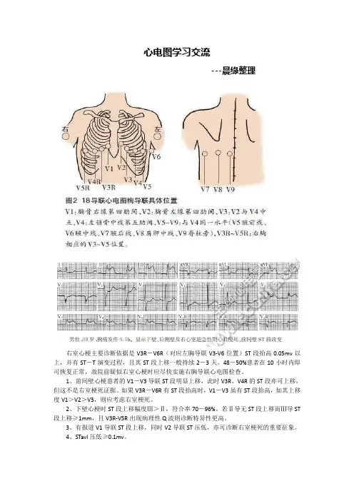 常见误诊心电图分析,整理