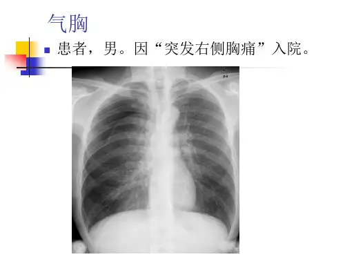 气胸与颅内血肿粗略估算、颅内出血性疾病