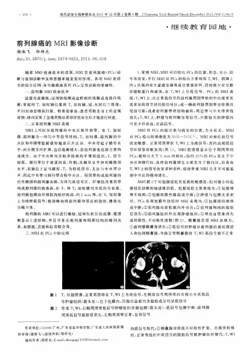 前列腺癌的MRI影像诊断