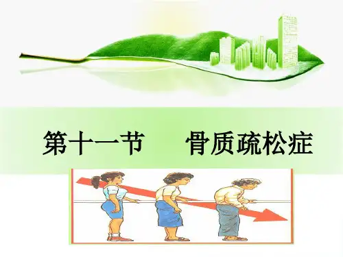 骨质疏松症