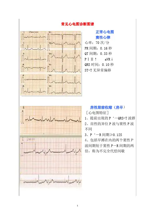 常见心电图诊断图谱