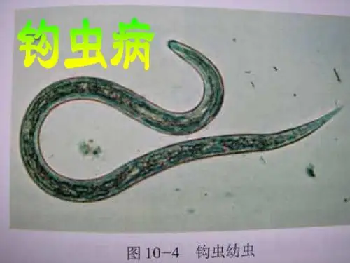 钩虫病