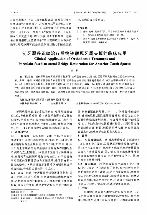 前牙漂移正畸治疗后烤瓷联冠牙周夹板的临床应用