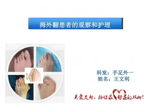 拇外翻