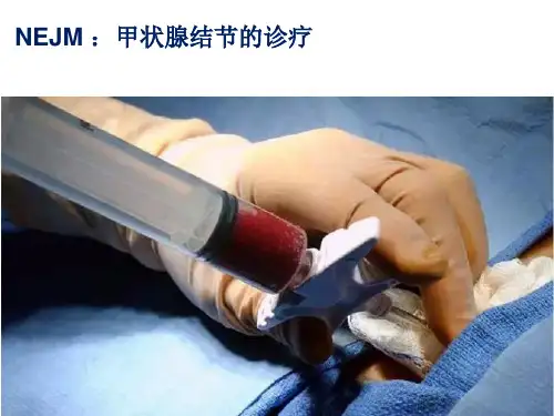 甲状腺结节