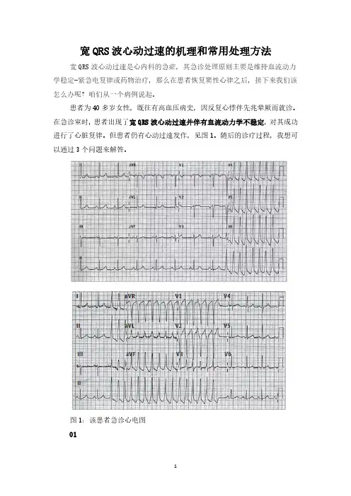 宽QRS波心动过速的机理和常用处理方法