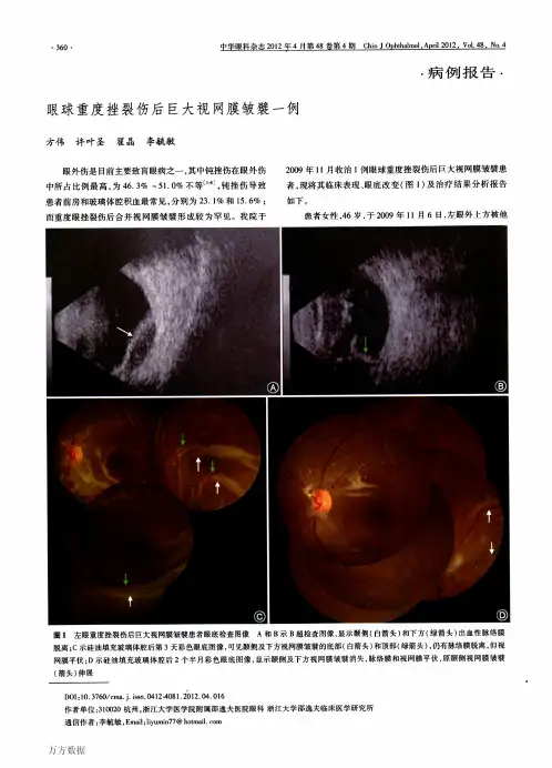 眼球重度挫裂伤后巨大视网膜皱襞一例