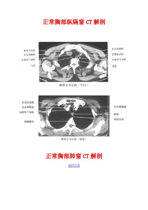 正常胸部纵隔窗CT解剖