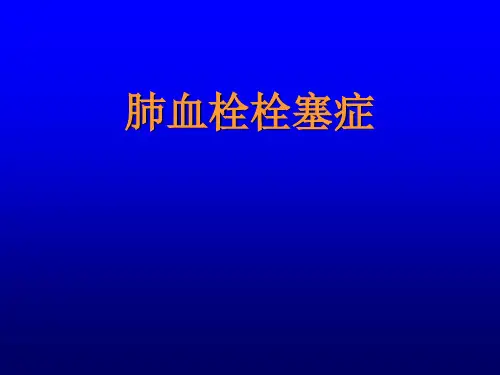 肺动脉栓塞