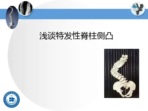 青少年特发性脊柱侧凸