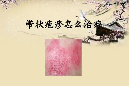 带状疱疹怎么治疗-精品