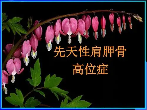 先天性肩胛骨高位症