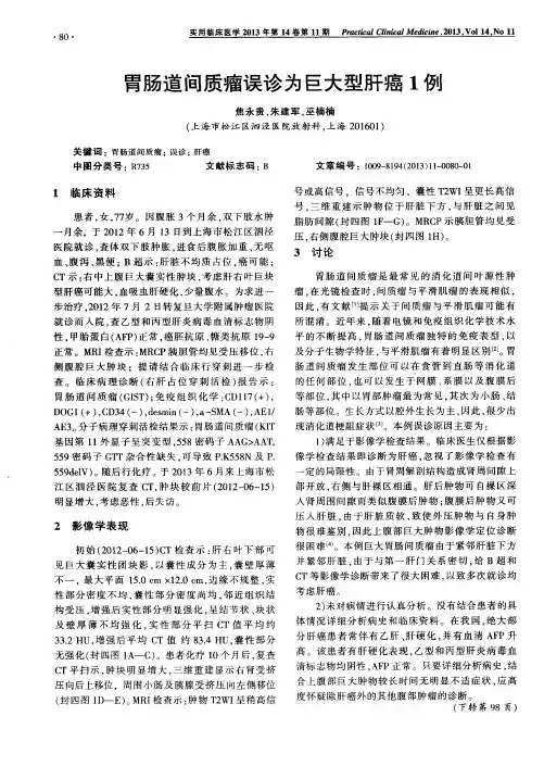 胃肠道间质瘤误诊为巨大型肝癌1例