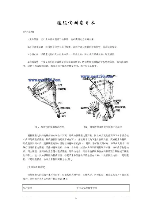 腹股沟斜疝手术