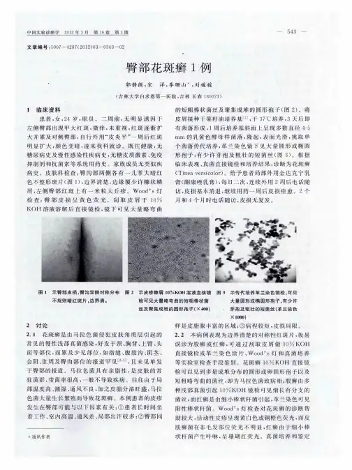 臀部花斑癣1例