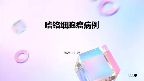 嗜铬细胞瘤病例