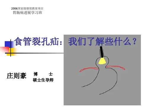 食管裂孔疝