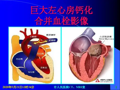 巨大左心房钙化合并血栓影像