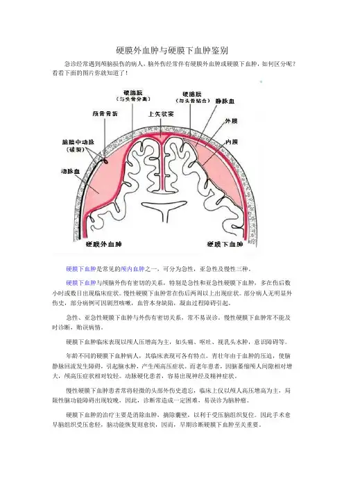 硬膜外血肿与硬膜下血肿鉴别