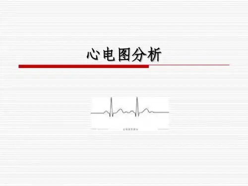 11.心电图分析