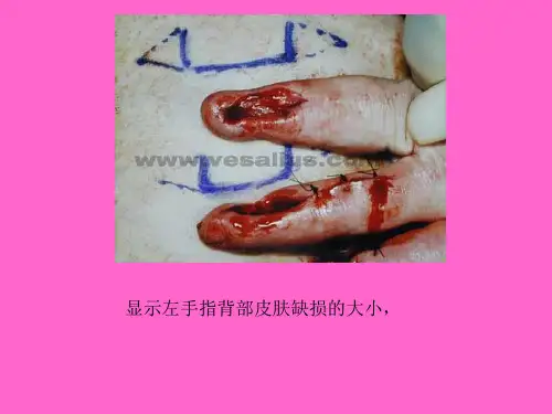 手指腹部皮瓣