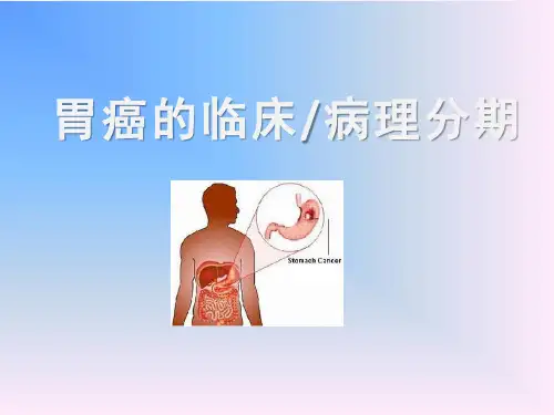 胃癌的临床病理分期