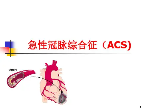 急性冠脉综合征PPT课件
