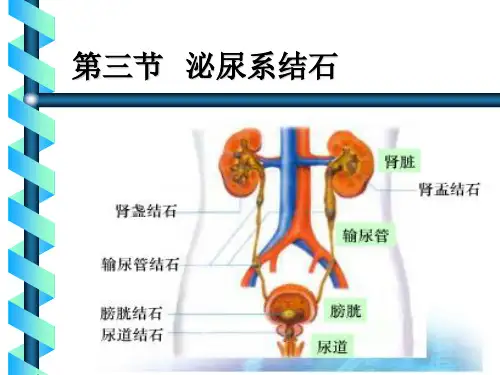 泌尿系结石 (2)