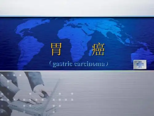 胃癌
