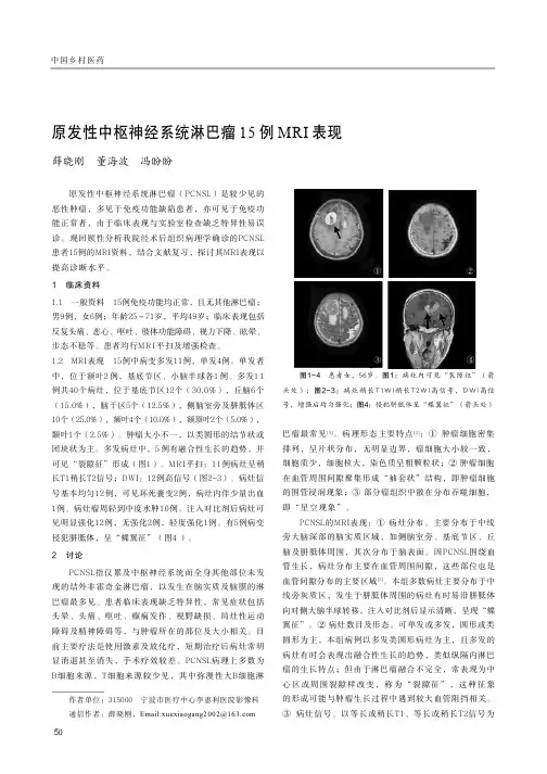 原发性中枢神经系统淋巴瘤15例MRI表现
