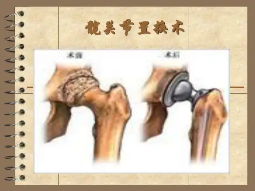 髋关节置换术康复PPT课件