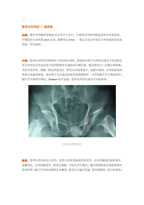股骨头坏死的X、CT、MRI的影像诊断!