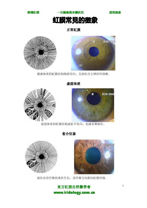 《虹膜诊断学常见的征象》-虹膜检测可评估健康状况？内部学习资料