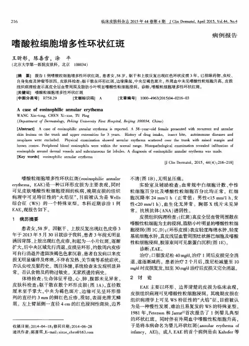 嗜酸粒细胞增多性环状红斑