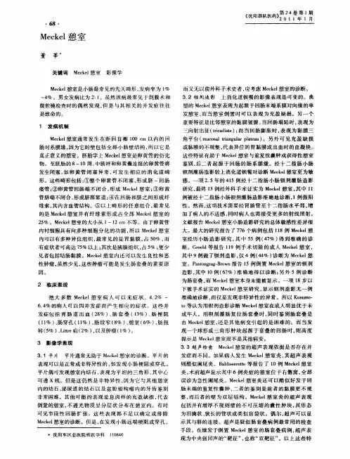 Meckel憩室