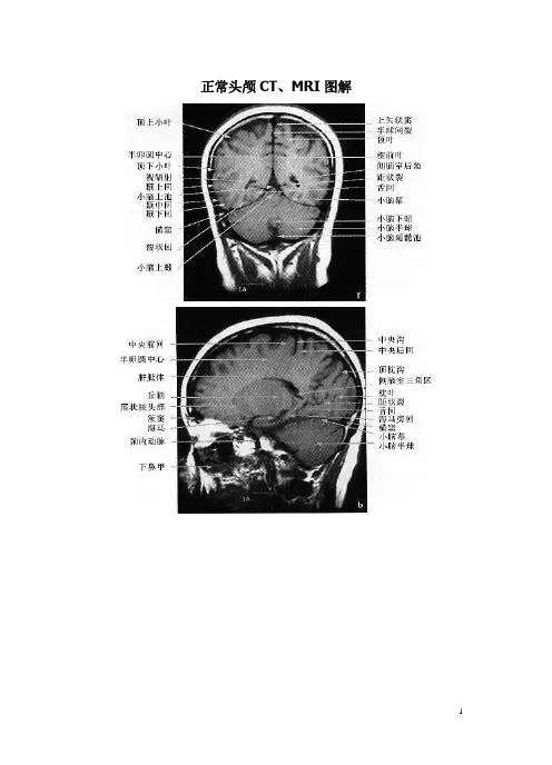 142532_正常头颅CT、MRI图解3