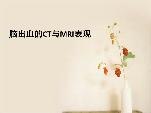 脑出血的影像学表现汇总.