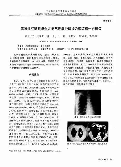 系统性红斑狼疮合并支气管囊肿误诊为肺结核一例报告
