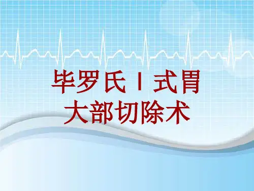 手术讲解模板:毕罗氏Ⅰ式胃大部切除术