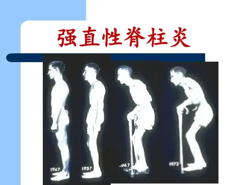 强直性脊柱炎影像诊断
