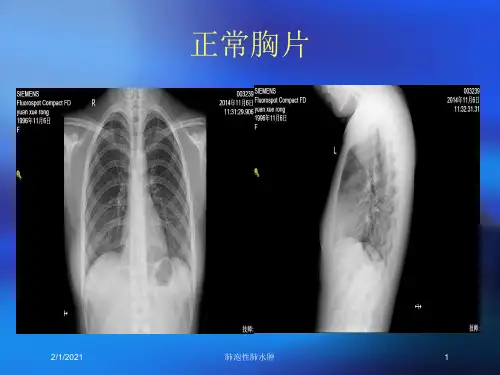 肺泡性肺水肿培训课件