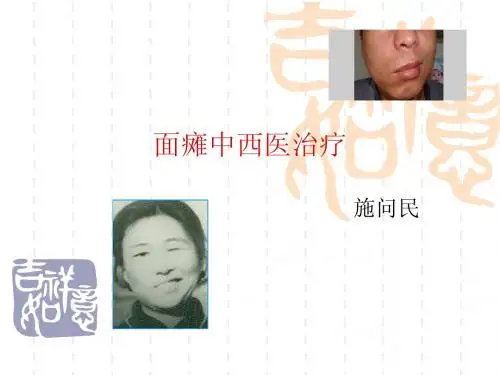 面瘫中西医治疗