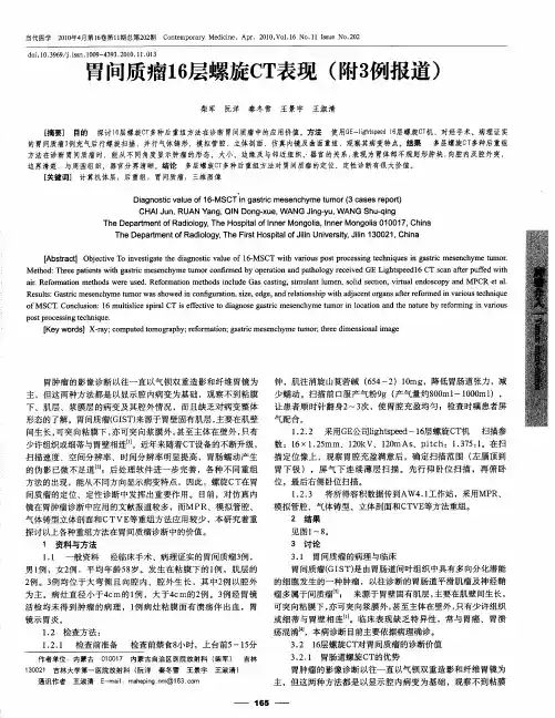 胃间质瘤16层螺旋CT表现(附3例报道)
