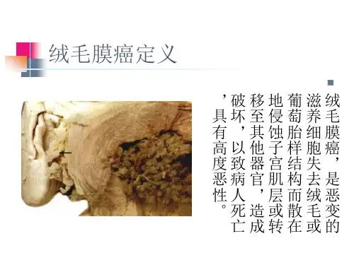 (完整版)绒癌护理查房