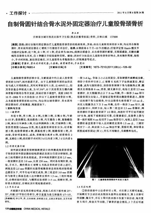 自制骨圆针结合骨水泥外固定器治疗儿童股骨颈骨折