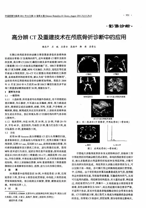 高分辨CT及重建技术在颅底骨折诊断中的应用