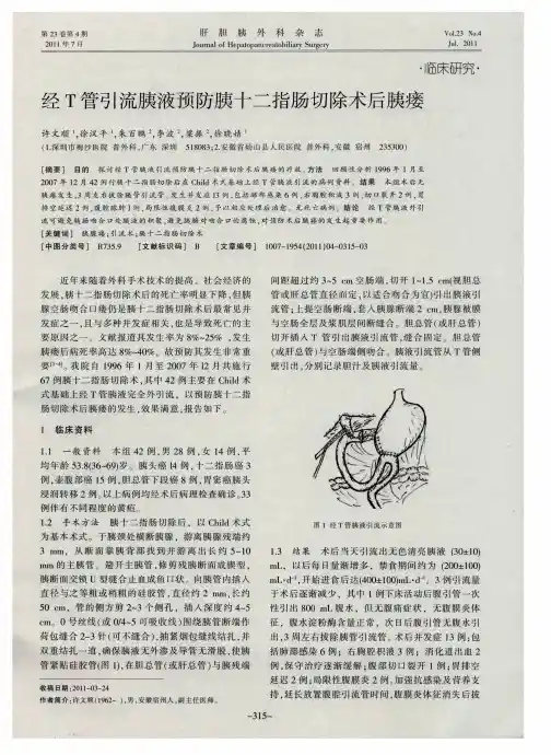 经T管引流胰液预防胰十二指肠切除术后胰瘘
